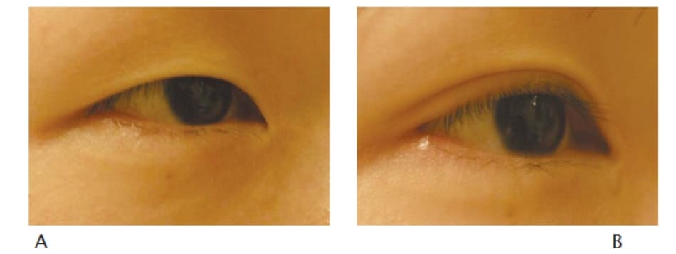 Hình 12-14 Tiền phẫu (A) và hậu phẫu 6 tháng theo phương pháp phẫu thuật khóe mắt ngoài của Lim đi kèm phẫu thuật mắt hai mí (B).