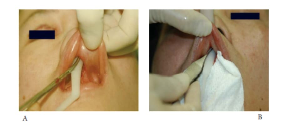 Hình 16-4 (tiếp) A, Thanh cấy được điều chỉnh và hướng đến điểm vượt ra xa đầu mũi. Một khi đầu implant đi vào phần thấp túi ở vùng sống mũi, implant sẽ trượt rất nhẹ nhàng. B, Một miếng gạc vô khuẩn 4x4 sẽ bảo vệ implant khỏi nước dãi.