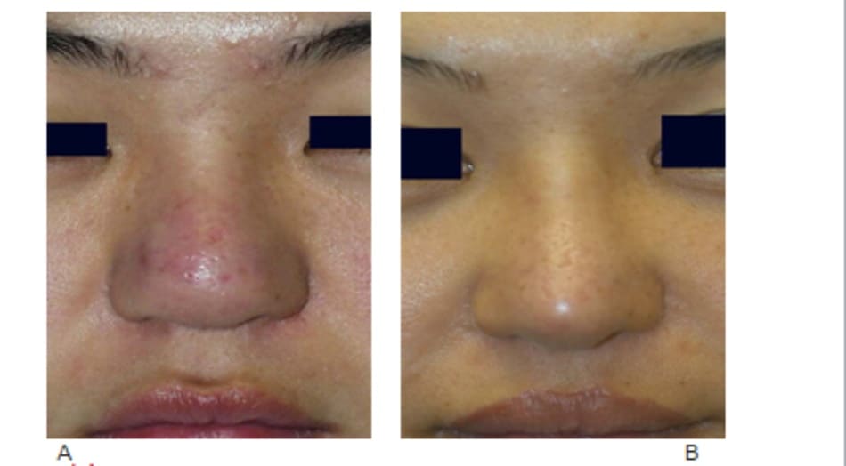 Hình 17-10 A, Hình ảnh trước mổ cho thấy da dầy và đầu mũi to rộng. B, Hình ảnh sau phẫu thuật cho thấy đầu mũi định hình sắc nét hơn và nhô cao.