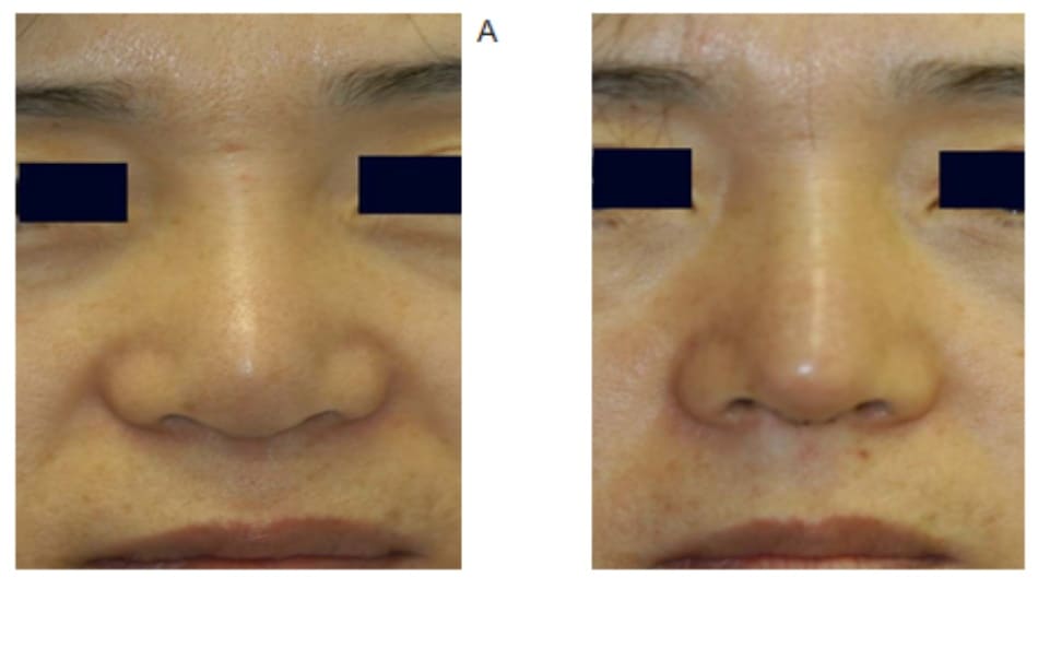 Hình 17-7 A, Hình ảnh trước phẫu thuật cho thấy đầu mũi bị xẹp. B, Hình ảnh sau phẫu thuật cho thấy đầu mũi gọn hơn, nét cong mềm mại, lỗ mũi hiện diện rõ hơn, và thu hẹp được nền cánh mũi. 