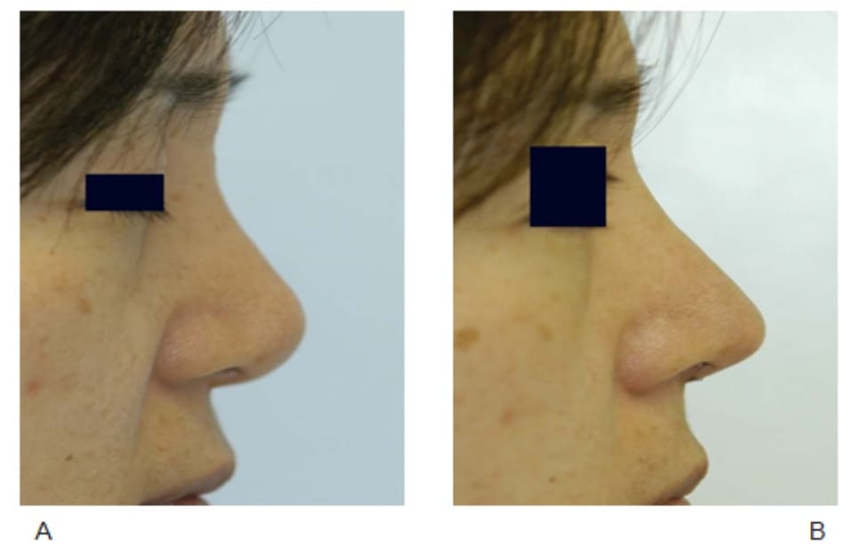 Hình 17-8 A, Hình ảnh trước phẫu thuật. B, Hình ảnh sau phẫu thuật cho thấy đầu mũi nhô ra trước nhiều hơn và cải thiện góc trụ mũi - môi.