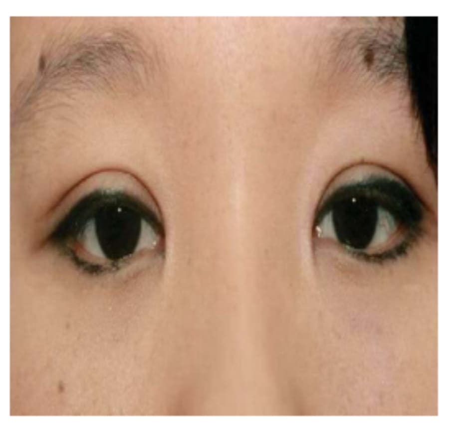 Hình 1-11 Đôi mắt có vẻ tròn vì nếp gấp quạt và nếp gấp hai mí cao.