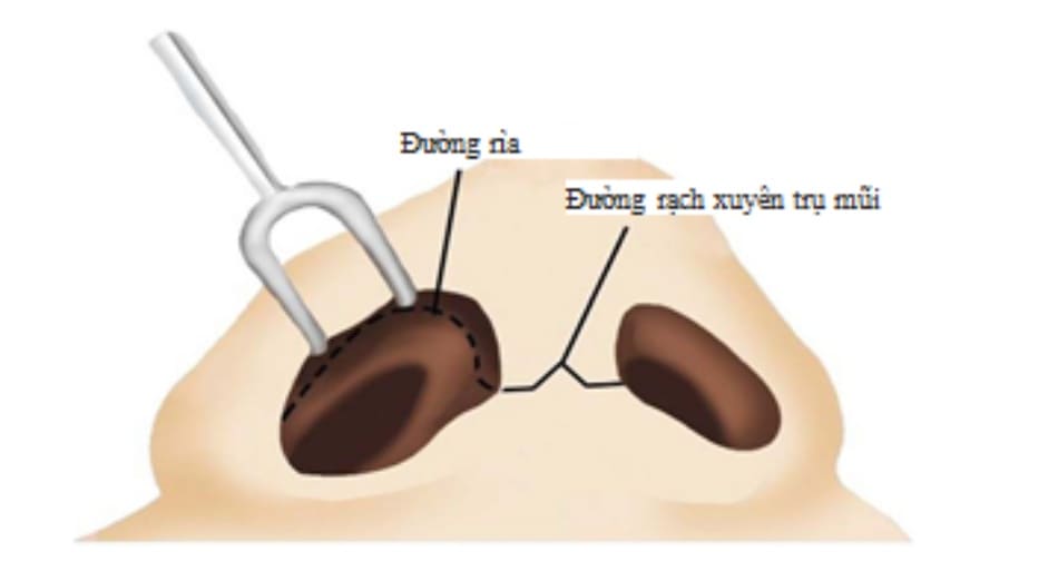 Hình 20-7 Các đường rạch rìa và ngang sụn mũi trong cách phẫu thuật mũi hở.