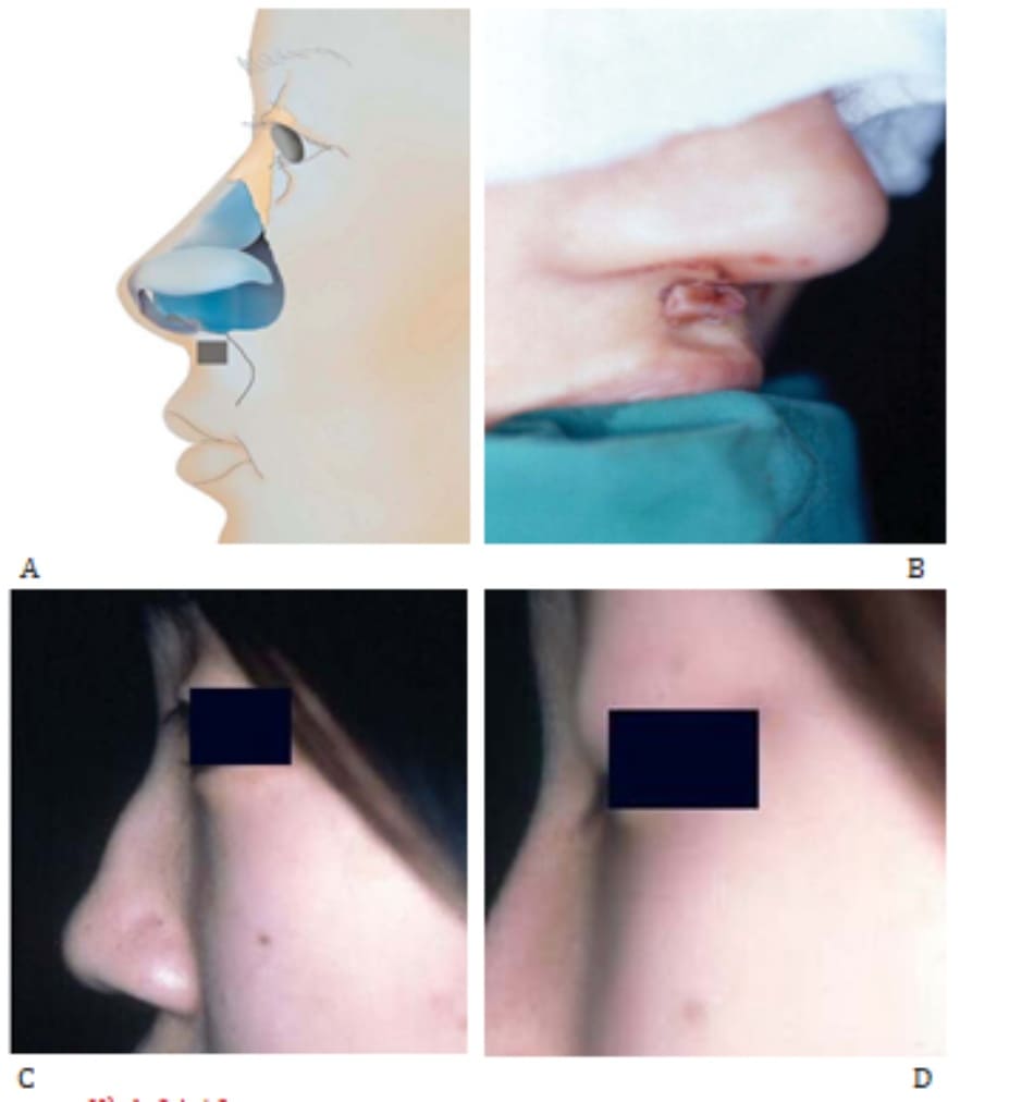  Hình 24-10 A và B, Vạt phồng. Hình ảnh tiền phẫu (C) và Hình ảnh hậu phẫu (D) cho thấy cải thiện góc mũi môi.