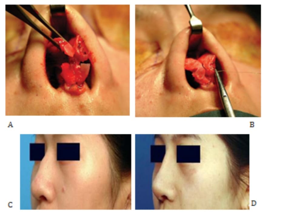 Hình 24-12 A và B, Hình ảnh trong phẫu thuật. Hình ảnh tiền phẫu (C) và hình ảnh hậu phẫu (D) cho thấy vùng chóp mũi được làm hẹp nhưng chiều cao vẫn được giữ.