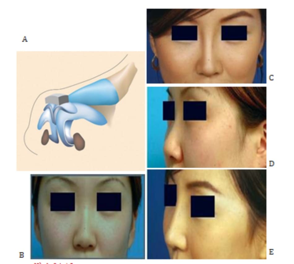 Hình 24-13 A, LLC được gia cố bằng sụn vành tai trước khi thực hiện quy trình xử lý chóp. B và C, Hình ảnh tiền phẫu. D và E, Hình ảnh hậu phẫu. 
