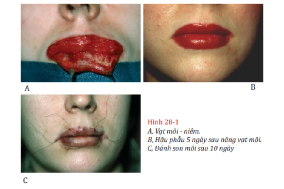 Hình 28-1 A, Vạt môi - niêm. B, Hậu phẫu 5 ngày sau nâng vạt môi. C, Đánh son môi sau 10 ngày