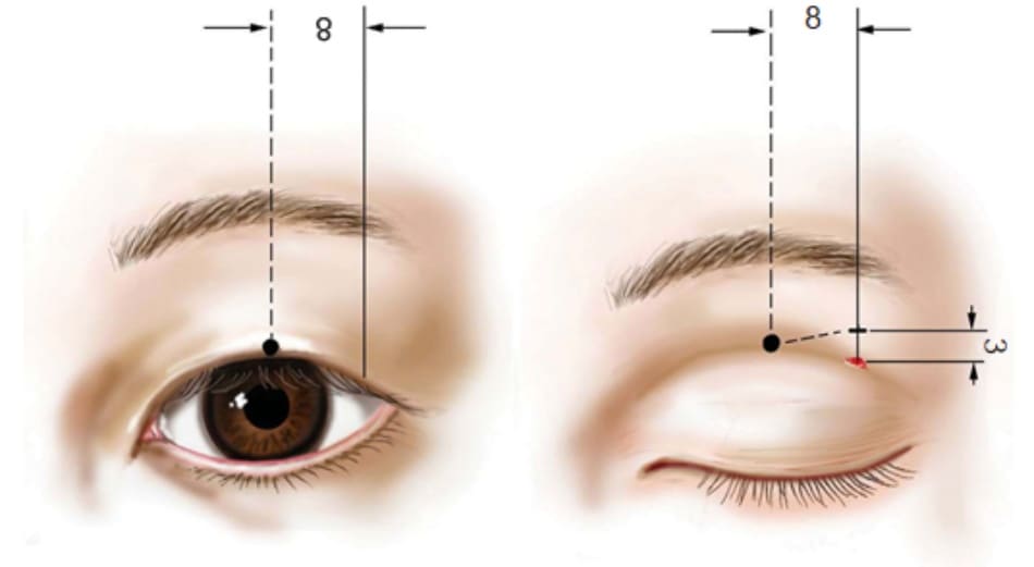 Hình 2-12 Sơ đồ hiển thị các phương pháp thiết kế. Điểm màu hồng là chỉ số chiều rộng tự nhiên. “Mắt mở” cho thấy một điểm ở rìa mí trên; “mắt nhắm” cho thấy điểm giống nhau trên da mí mắt như trên “mắt mở”.