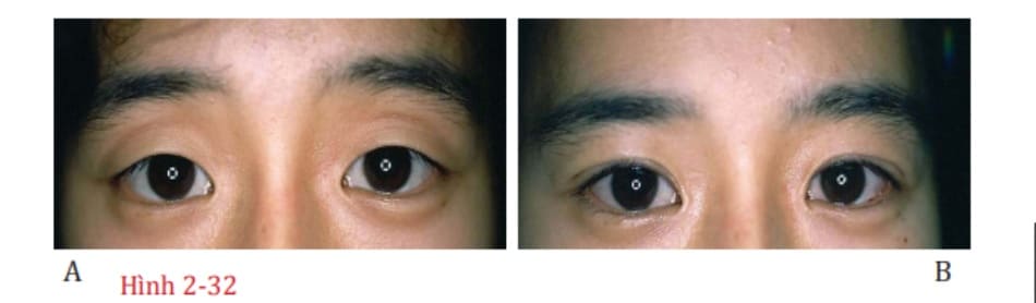 Hình 2-32 Một mí đôi hẹp về chiều rộng so với nếp gấp da tự nhiên sẽ cải thiện vẻ trầm buồn ở mí mắt trên, tương tự như rèm.