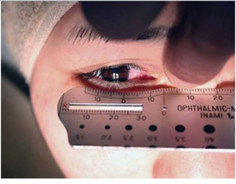 Hình 2-5 Đặt dụng cụ đo nhãn khoa trên khóe mắt trong, trong khi nếp gấp Mongo- lian được kéo bằng ngón tay.