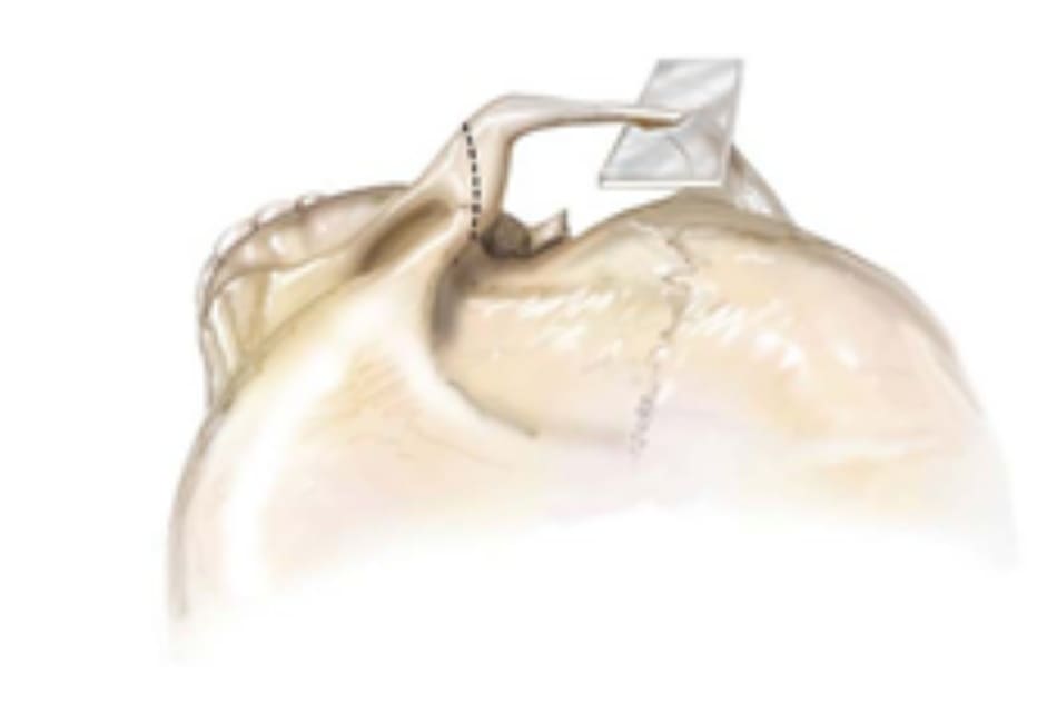 Hình 34-4 Góc nhìn phức hợp gò má từ trên xuống. Vị trí cắt xương được minh họa như trong hình. Việc bóc tách phải mở rộng đến xương hàm trên và gần thành bên ổ mắt.