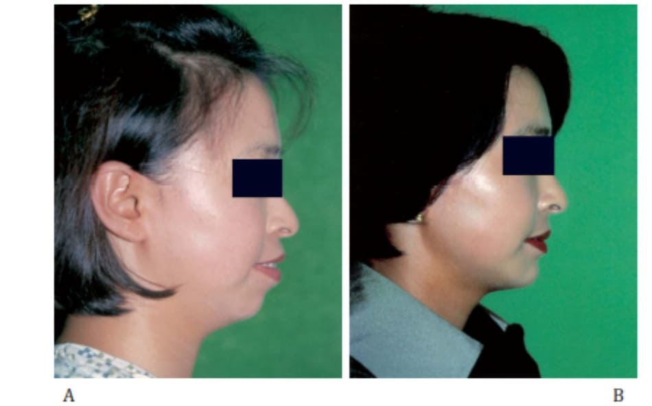  Hình 35-4 A,Cận cảnh nhìn từ phía trước và phía bên một người nữ 25 tuổi bị hô. B, Hình ảnh sau phẫu thuật cắt phần trước xương hai hàm trên dưới 13 tháng.
