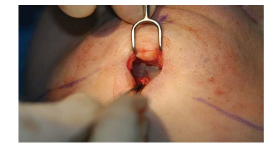 Hình 36-5 Khấc giữa của implant đươc đặt chính xác vào đường giữa.