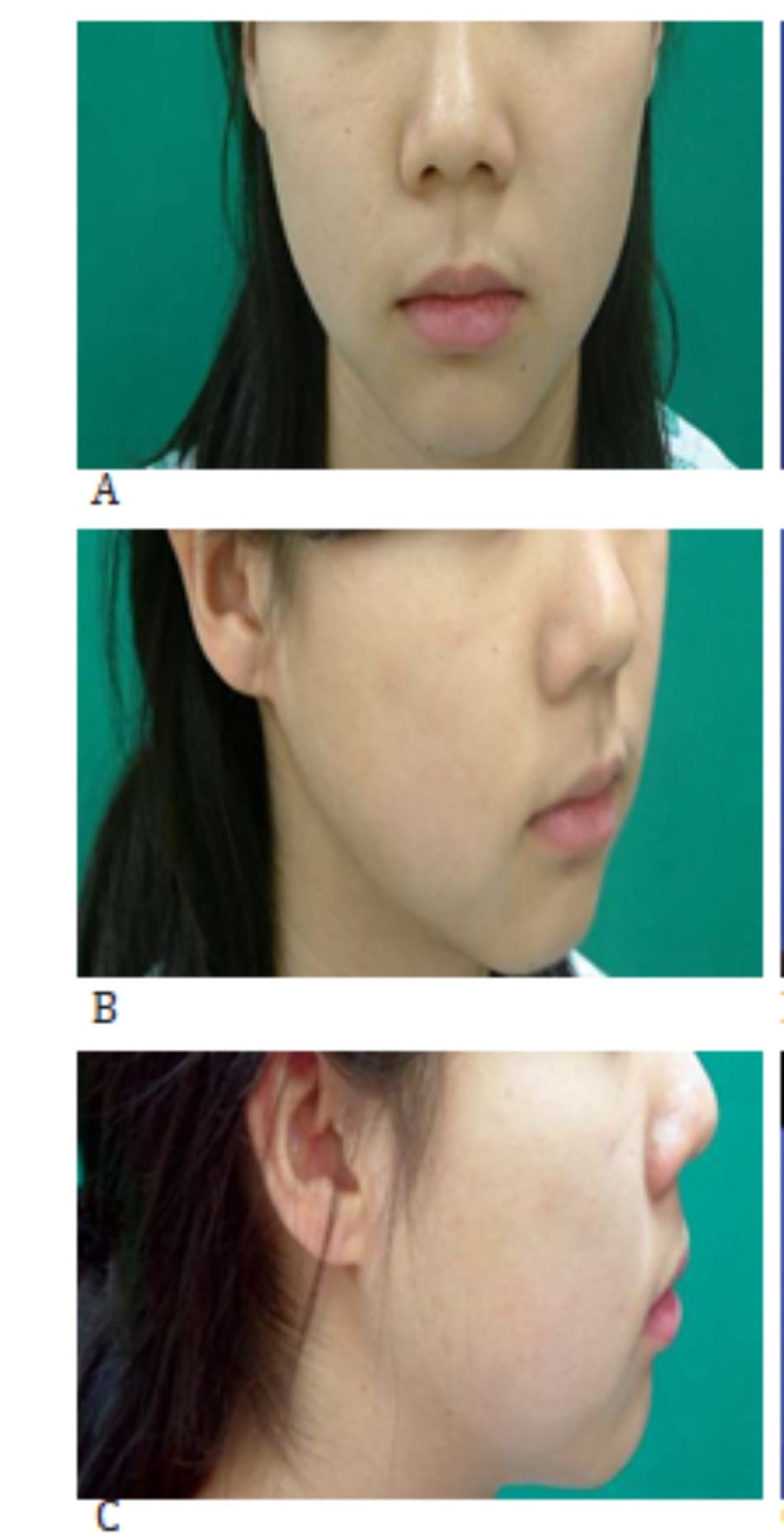Hình 37-4 A đến C, cận cảnh khuôn mặt trước phẫu thuật của bệnh nhân có cằm lẹm 