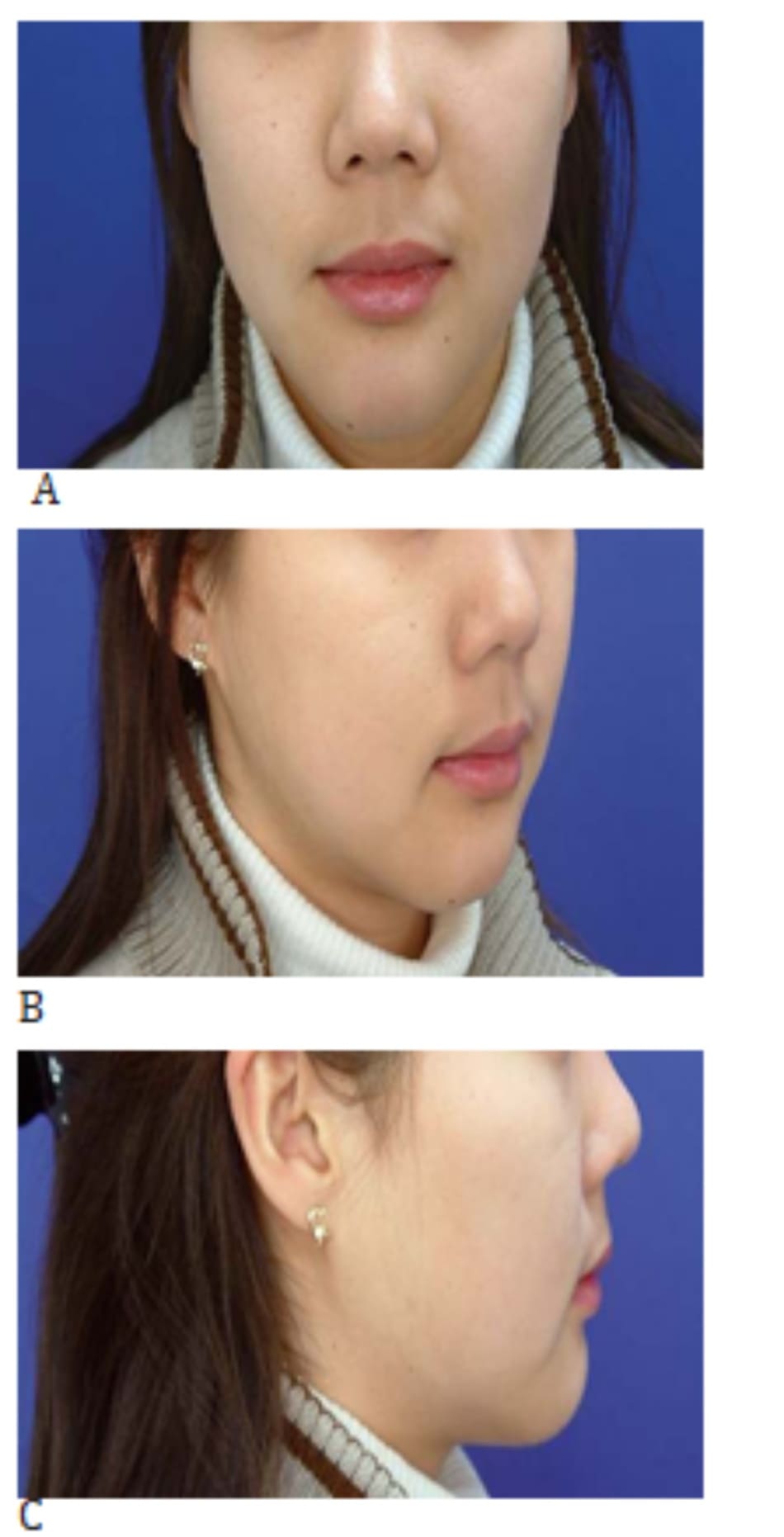 Hình 37-5 A đến C, cận cảnh khuôn mặt sau phẫu thuật nâng cằm (nâng 4 mm) 