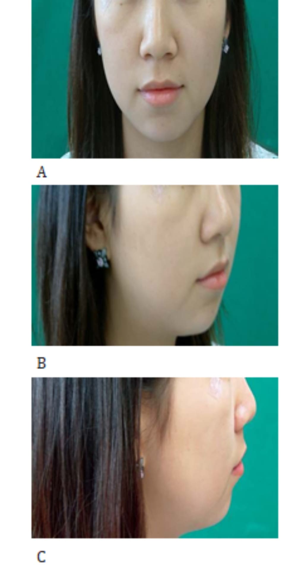 Hình 37-6 A to C, Preoperative facial views of a patient with a retruded chin.