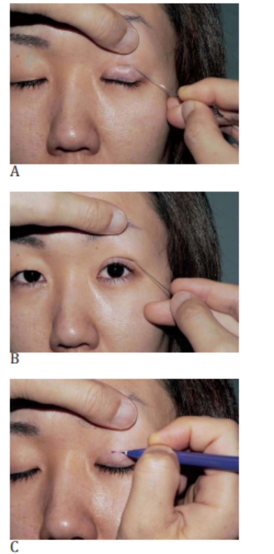 Hình 4-1 A, Nhấn que thông lệ đạo vào mí mắt trên. B, Nếp gấp hai mí được mô phỏng, C, Vẽ đường rạch.