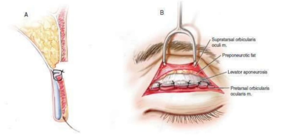 Hình 6-1 Hình ảnh minh họa điểm tiếp xúc rộng giữa cơ nâng mi bị gấp và cơ vòng mi mắt.