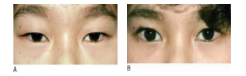 Hình 6-12 A, Tiền phẫu. B.Giấu nấp hai mí, nhưng mắt mở to hơn do kết quả cố định cơ nâng.