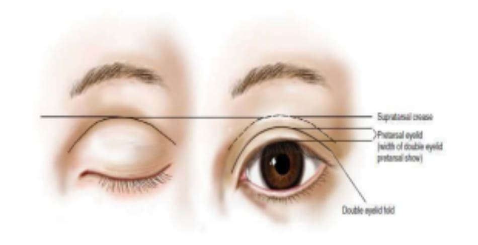 Hình 6-13 Nếp trên sụn mi là vị trí cố định; khi mắt mở, một nếp gấp đôi được tạo thành. Phần mi mắt trước sụn mi được bộ lộ khi mắt mở sẽ tạo nên hình ảnh vùng trước sụn mi. Mức độ của vùng trước sụn mi còn được mô tả là chiều cao nếp gấp mí đôi.