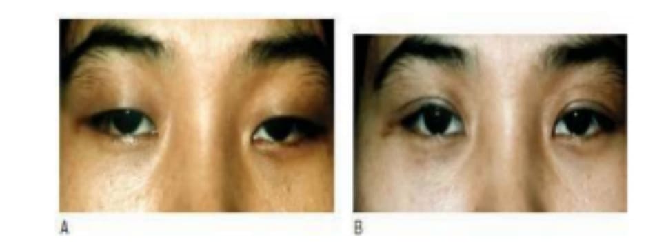 Hình 6-15 A, Tiền phẫu. B, Loại bỏ tích cực mô mỡ tạo nếp gấp phụ ở mắt trái.