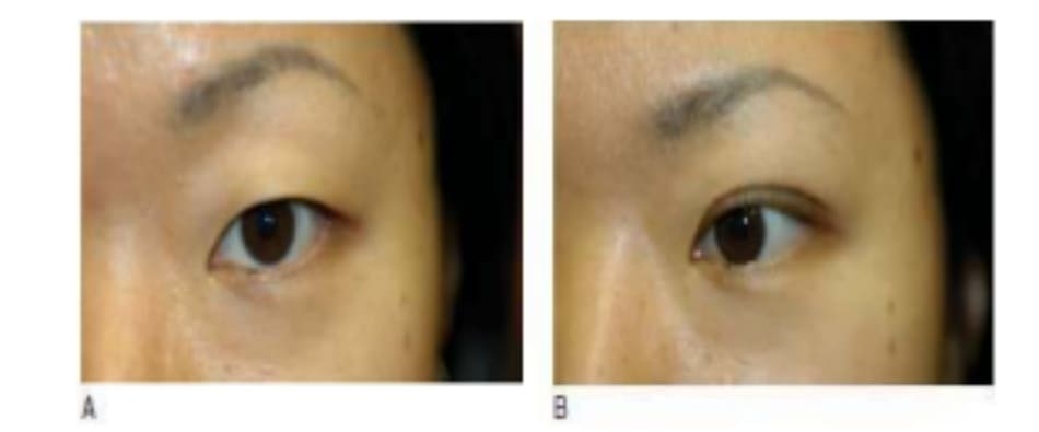 Hình 6-16 A, Hình ảnh tiền phẫu cho thấy vị trí cung mày cao, kết quả của tình trạng không chú ý nâng lớp da lỏng lẻo mí mắt trên để nhìn rõ. B, Hình ảnh hậu phẫu cho thấy vị trí cung mày thấp do không có nhu cầu nâng cung mày bù trừ.