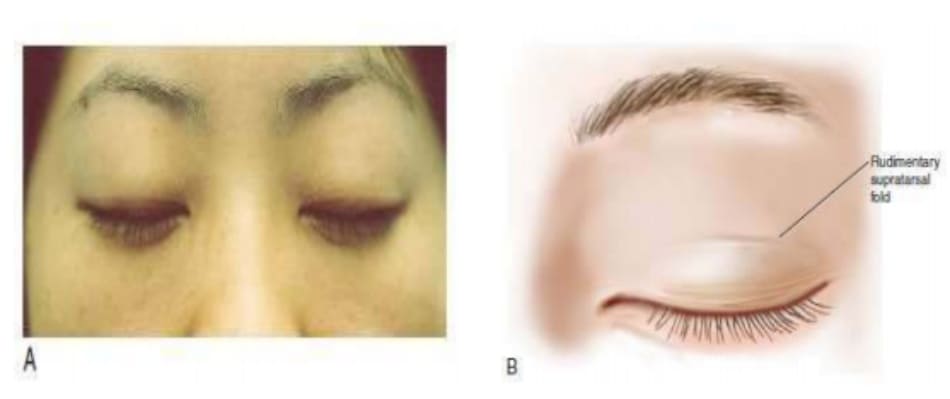 Hình 6-5 A, Đường sơ khởi của nếp trên sụn mi thường thấy ở bệnh nhân mắt một mí. Đường rạch được đánh dấu trên hoặc song song với đường này. B, Minh họa đường sơ khởi.