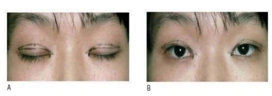 Hình 6-6 A, Chỉ rạch da mí mắt có mô thừa nhiều. B, Góc nhìn mắt mở. 