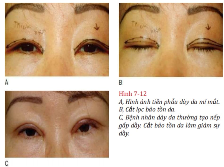 Hình 7-12 A, Hình ảnh tiền phẫu dày da mí mắt. B, Cắt lọc bảo tồn da. C, Bệnh nhân dày da thường tạo nếp gấp dầy. Cắt bảo tồn da làm giảm sự dầy.