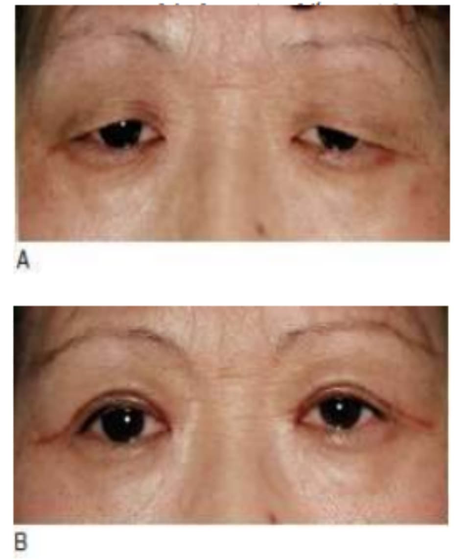  Hình 7-14 A, Tiền phẫu. B, Hậu phẫu 1 tháng cho thấy dầy đáng kể mi mắt và ửng đỏ đường rạch.