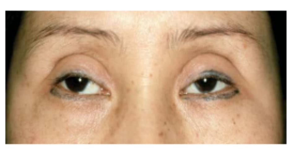 Hình 7-2 Mắt trũng sau phẫu thuật mí mắt dựa trên các nguyên tắc phẫu thuật cho người da trắng.