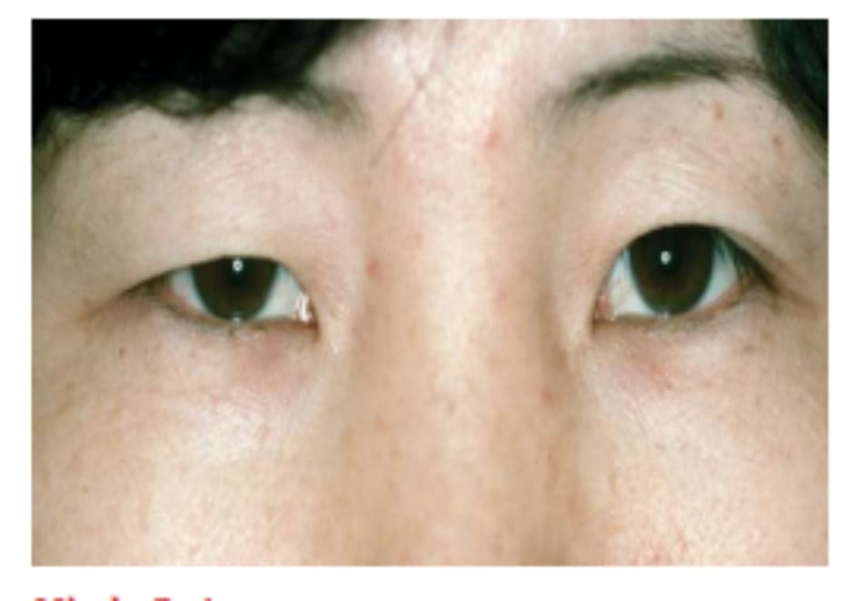 Hình 8-1 Mí mắt bất xứng và tái hồi. Mí mắt trên bên phải giả sụp mi do rũ da mí 