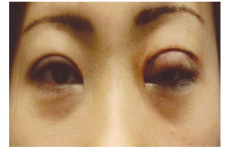 Hình 8-11 Sụp mi tạm thời do phù hậu phẫu từ phẫu thuật tái chỉnh mi mắt một bên. Mắt trở lại cân xứng khi vết thương lành.