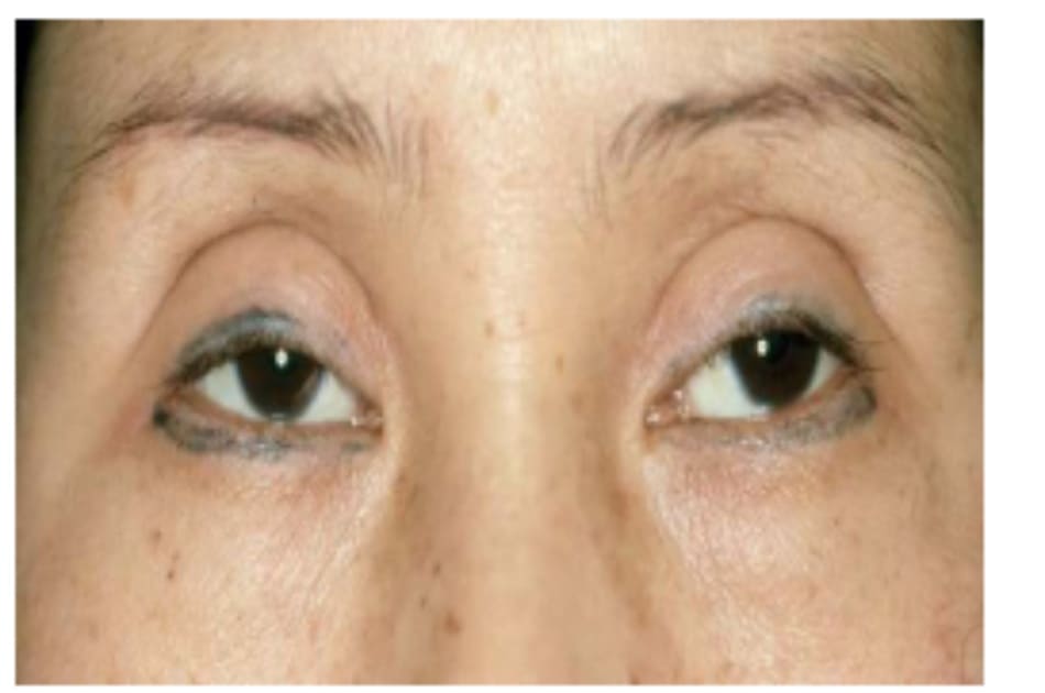  Hình 8-8 Mắt trũng là kết quả của việc loại bỏ nhiều mô mỡ và da. 