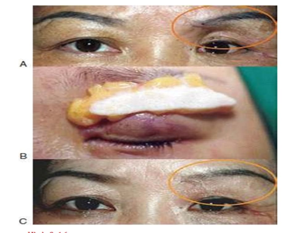 Hình 9-16 Mi mắt trũng. Tiền phẫu (A), vạt da cơ (B), và (C) hậu phẫu.