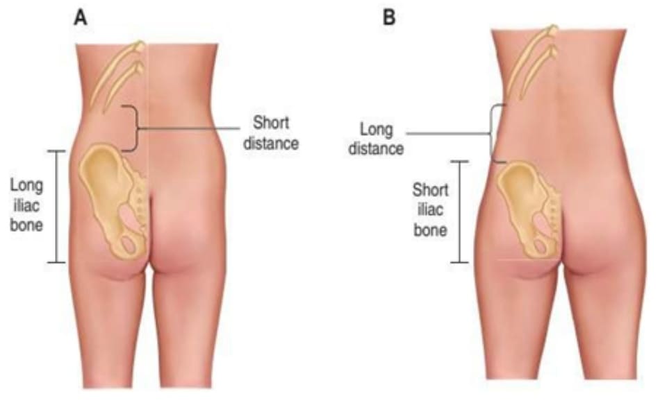 Hình. 2. (A) Hình minh họa cấu trúc xương chậu dài/cao nhưng không đủ rộng, đồng thời khoảng cách từ xương chậu tới khung sườn sẽ ngắn lại. Đây là hình thái phức tạp nhất, bệnh nhân phải được thực hiện hút mỡ trước ở vùng eo, mạng sườn sau đó chuyển mỡ để nâng mông phần giữa ngoài thì mới có thể đặt được hình thể eo/hông “đồng hồ cát”. (B) Hình thái thuận lợi nhất trong chuyển mỡ, chiều cao của khung chậu tương đối cùng với khoảng cách từ khung chậu đến khung sườn dài, đồng thời độ rộng của khung chậu cũng vừa đủ.