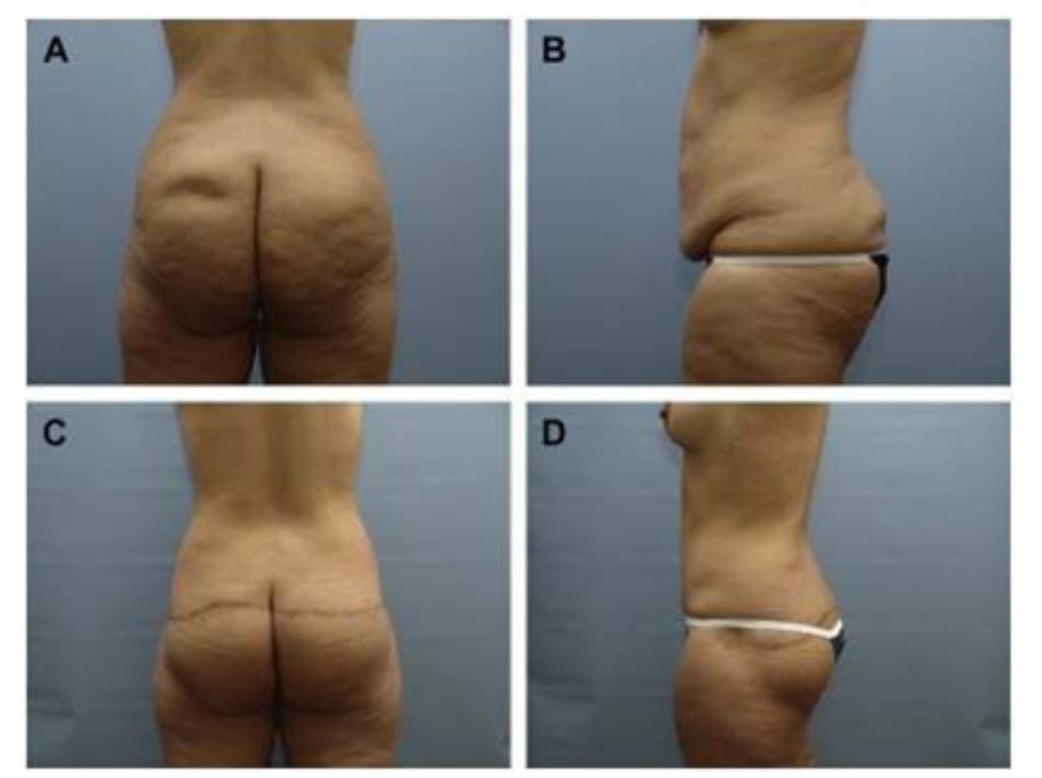  Hình. 11. (A, B) Bệnh nhân nữ 59 tuổi với vùng da mông chùng và xệ. (C,D) Hai năm sau phẫu thuật tạo hình thành bụng và tạo hình mông bằng phương pháp purse-string.Bệnh nhân này bị tách vết mổ, sau đó đã được điều trị liền sẹo 