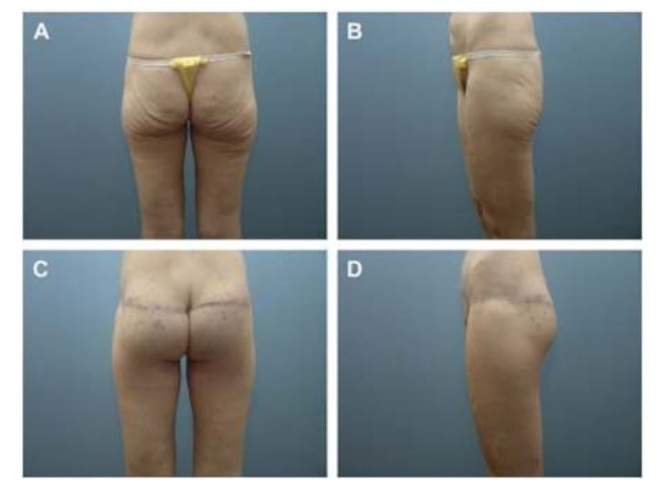  Hình. 12. (A, B) Bệnh nhân nữ 37 tuổi với vùng mông dẹt và xệ. (C,D) Tám tháng sau phẫu thuật tạo hình thành bụng và tạo hình mông bằng phương pháp purse- string . 
