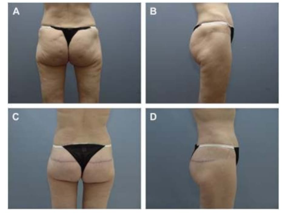 Hình. 13. (A, B) Một bệnh nhân 62 tuổi với vùng mông xệ và hình chiếu không thẩm mỹ. (C,D) Sau phẫu thuật 16 tháng tạo hình mông bằng phương pháp purse-string (đã tạo hình thành bụng trước đó).