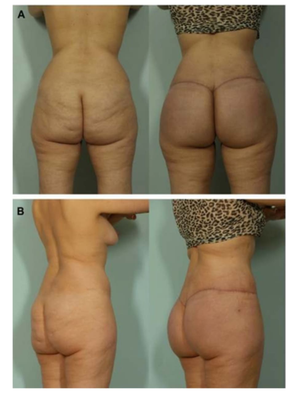 Hình. 5. Hình ảnh trước và sau phẫu thuật, chứng minh sự cải thiện về hình dáng mông và loại bỏ đi những bất thường.