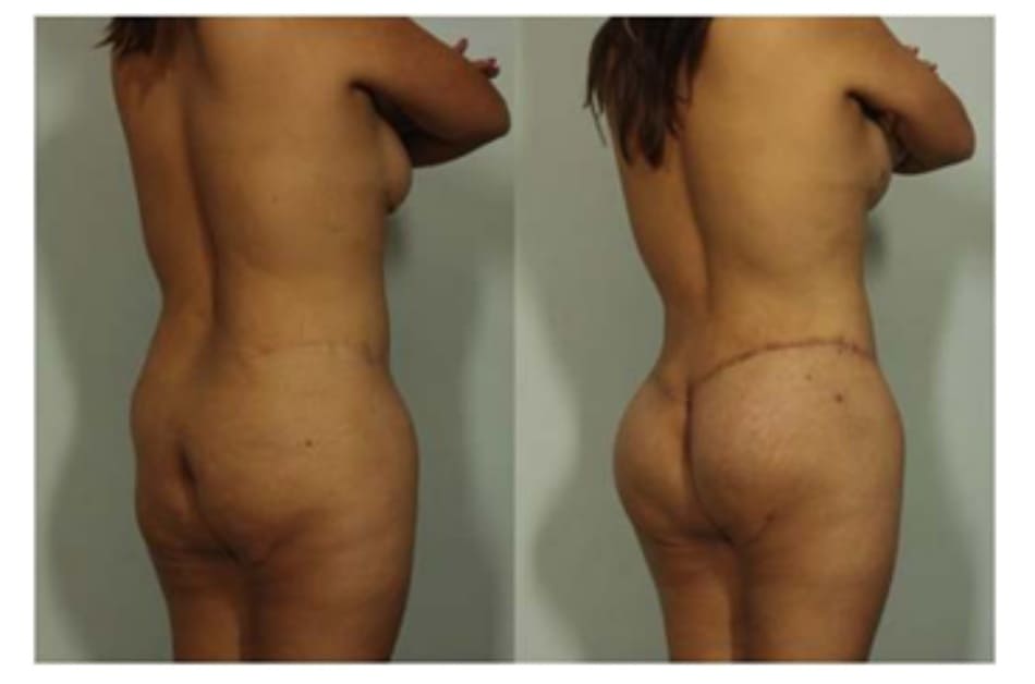 Hình. 7. Hình ảnh trước và sau phẫu thuật của một bệnh nhân đã từng thực hiện tạo hình thành bụng trước đó, chứng tỏ sự linh hoạt của ký thuật này trong việc tùy chỉnh vị trí sẹo (cao/thấp).