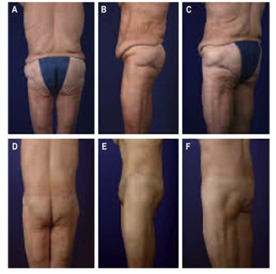 Hình. 1. CBL/EBL và vùng mông dẹt. (A-C) Hình ảnh phía sau, phía bên và chếch, trước phẫu thuật. (D-F) Hình ảnh phía sau, phía bên và chếch, sau phẫu thuật.