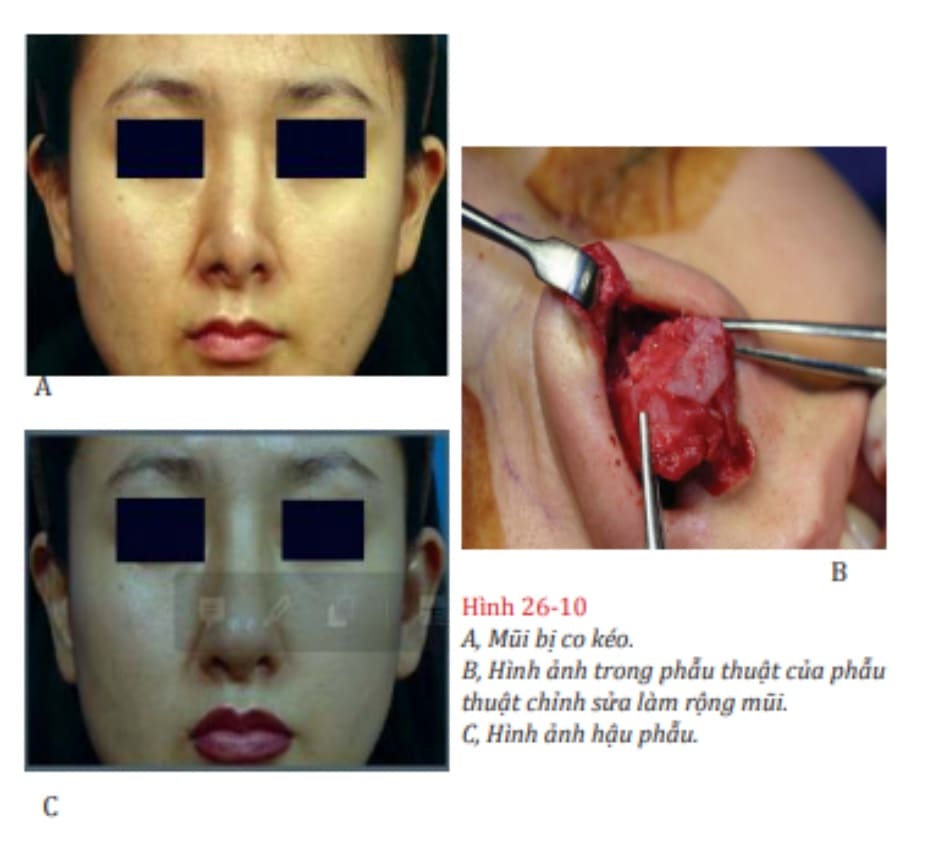 Hình 26-10 A, Mũi bị co kéo. B, Hình ảnh trong phẫu thuật của phẫu thuật chỉnh sửa làm rộng mũi. C, Hình ảnh hậu phẫu.