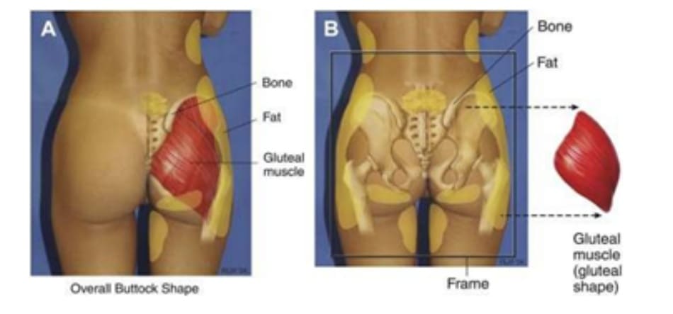 Hình 1. (A) Hình thể toàn bộ vùng mông phụ thuộc vào khung xương, cơ mông lớn, vị trí và lượng mỡ dưới da, độ căng của da. (B) Khung mông, với cơ mông lớn đã được tách ra.