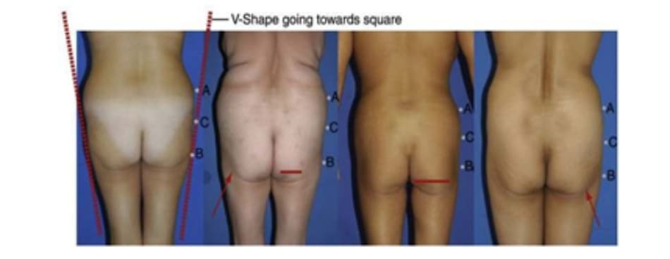 Hình. 13. Hình minh họa mông hình chữ V. Mũi tên màu đỏ cho biết đường ranh giới của mặt ngoài mông và mặt ngoài đùi: phương pháp trị liệu tốt nhất là cấy mô mỡ. Đường liền nét cho biết chiều rộng cơ mông lớn với bên trái là chiều rộng ngắn, bên phải là bình thường.