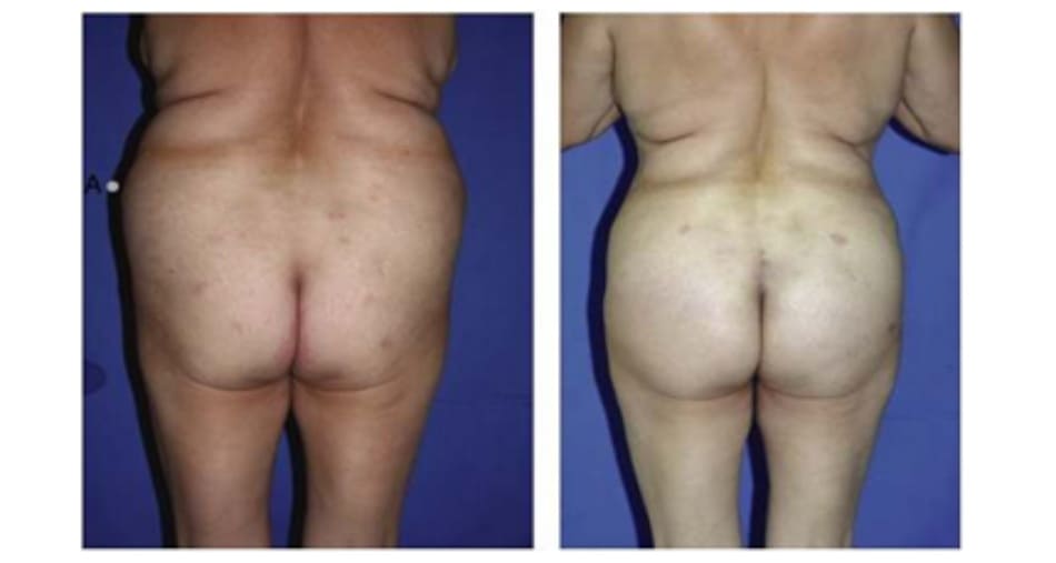 Hình. 15. Khung hình chữ V, cao với khối cơ mông lớn ngắn trước (trái) và sau (phải) phẫu thuật tạo hình.
