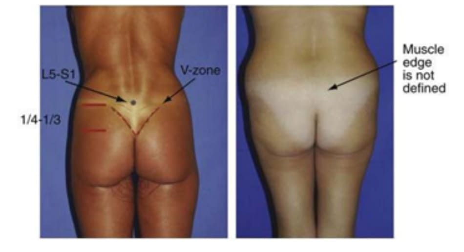Hình. 21. Đánh giá mối tương quan giữa cơ mông và vùng trên trong mông và tam giác cùng. Ở ảnh bên trái, điểm chấm đen là khớp gian đốt L5-S1, đường nét liền phía dưới đành dấu điểm cuối cùng của đường liên mông, và đường chấm đánh dấu điểm cuối cùng của bờ trên cơ mông lớn. Bệnh nhân ở phía bên trái có thể thấy rõ vùng chữ V cũng như bờ cơ mông lớn. Bệnh nhân bên phải không thấy vùng chữ V vì thiếu thể tích vùng mông cũng như thừa mỡ vùng V, vì thế trông mông sẽ bị dẹt.