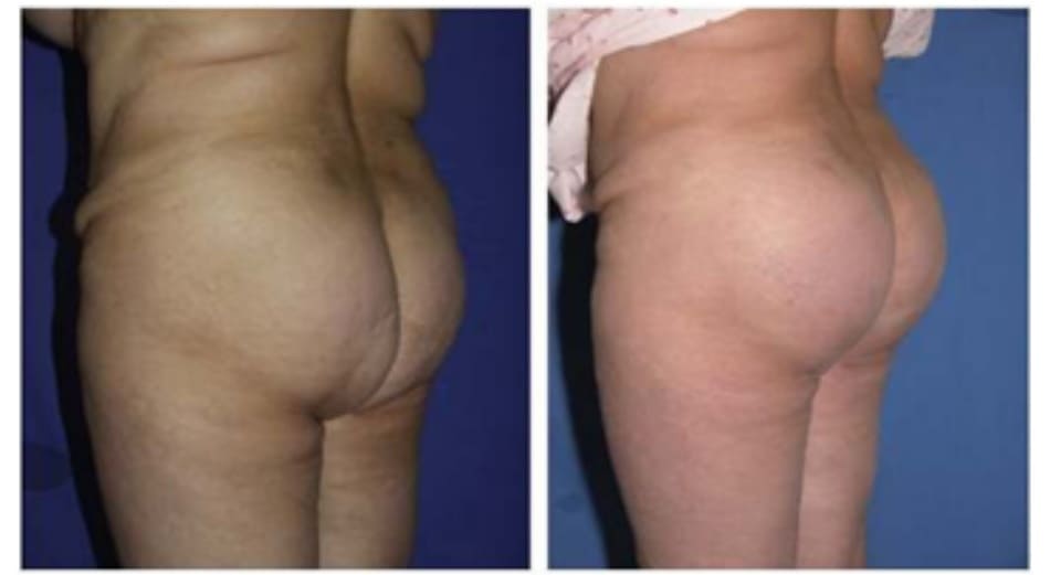 Hình. 23. Hình ảnh trước (trái) và sau (phải) của một bệnh nhân đã thực hiện nâng mông bằng thủ thuật cấy vòng lớn, nếp lằn mông cũ bỏ, kèm theo hút mỡ vùng mông trên và vùng dưới nếp lằn mông.