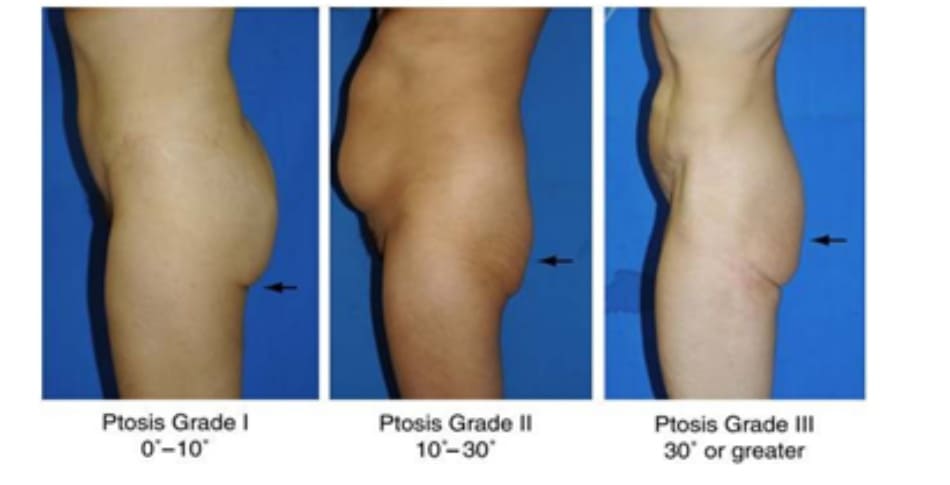 Hình. 28. Giai đoạn I, II, III của bệnh nhân có tình trạng sa mông. Ở giai đoạn I, góc tạo bởi nếp da nhỏ hơn 10 độ. Ở giai đoạn II, focs này rơi vào khoảng từ 10- 30 độ. Còn ở giai đoạn III, góc tạo bởi nếp da lớn hơn 30 độ. Ptosis Grade I 00-100: Sa mông GĐ I 00-100 Ptosis Grade II 100-300 Ptosis Grade III 300 or greater: Sa mông GĐ III 30° hoặc hơn