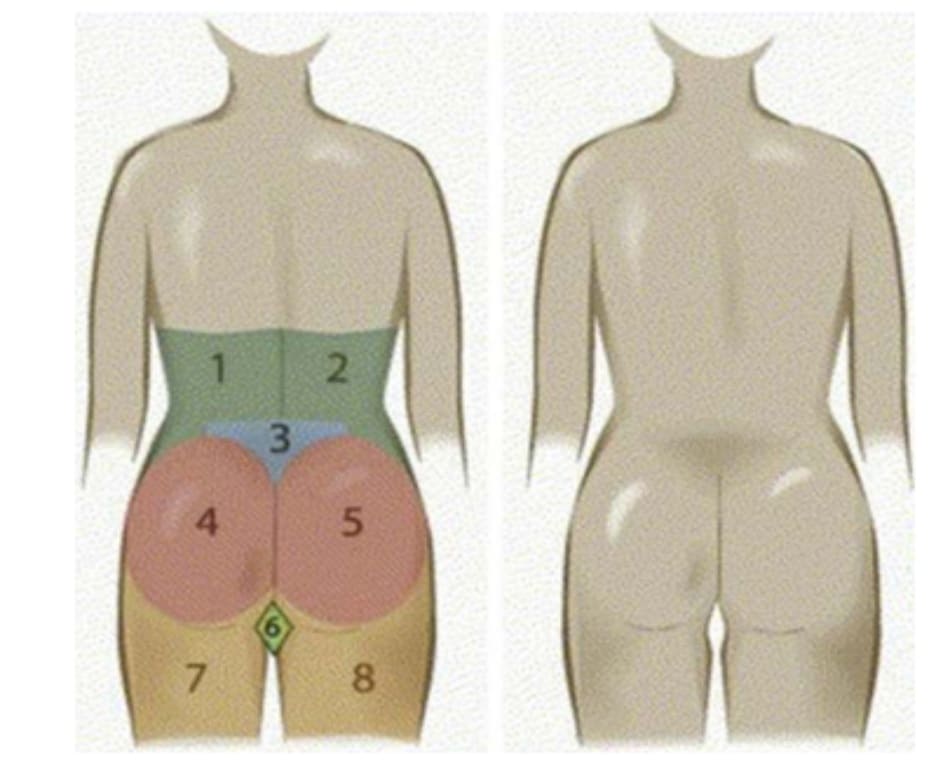 Hình. 3. 8 đơn vị thẩm mỹ vùng mông bao gồm 2 mạn sườn đối xứng 2 bên (1,2), 1 tam giác cùng (3), mông hai bên (4,5), 2 đùi sau đối xứng nhau (7 và 8), và 1 bộ phận giao thoa của 2 nếp lằn mông (hình thoi – 6) (Nguồn: Centeno RF. Gluteal aesthetic unit classification: a tool to improve outcomes in body contouring. Aes- thetic Surg J 2006;26(2):200-8)